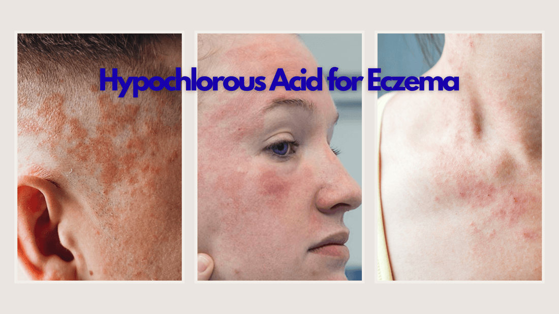Hypochlorous Acid Spray for Eczema - Endorphi